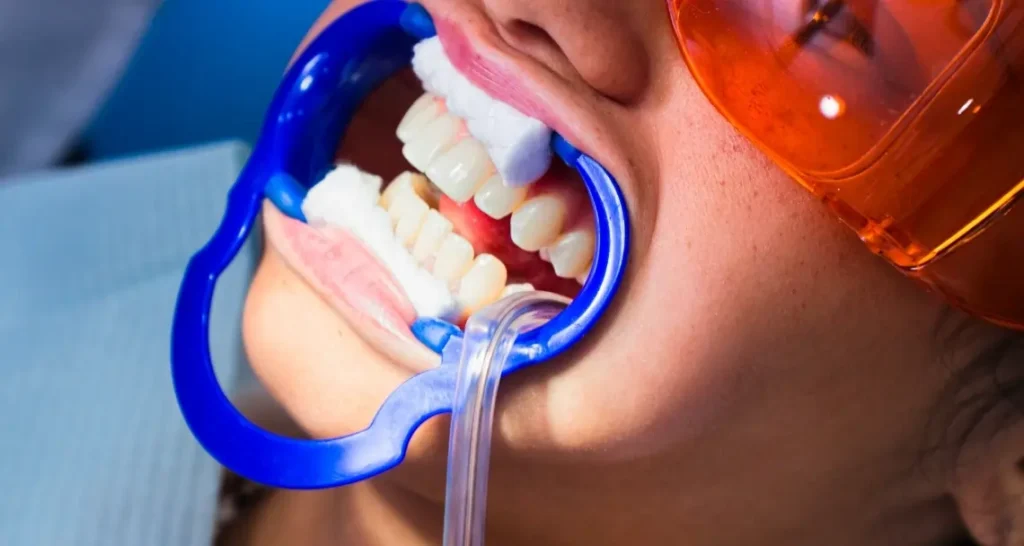 Illustration of teeth with surface-level yellow and brown stains caused by coffee and tobacco Reading