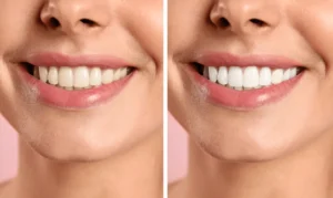 Smiling person undergoing Laser Teeth Whitening for a brighter smile Reading