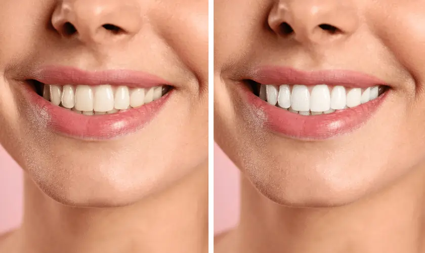 Smiling person undergoing Laser Teeth Whitening for a brighter smile Reading